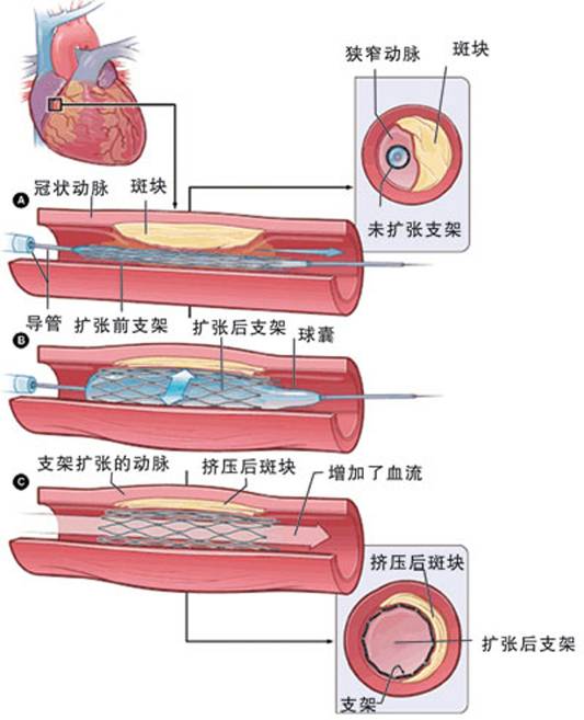 怎樣治療冠心??？(圖2)