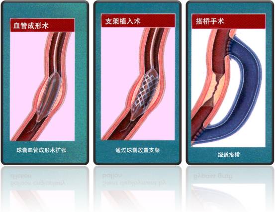 怎樣治療冠心??？(圖1)